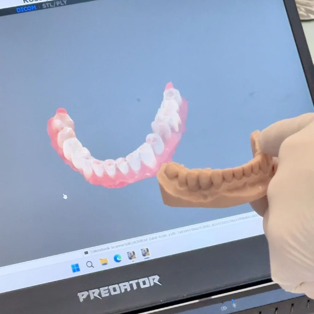 Differenza tra faccette dentali e corone
