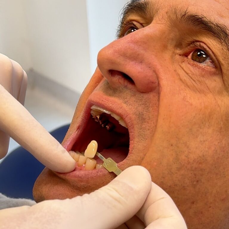 Come cambiano i denti con le faccette dentali