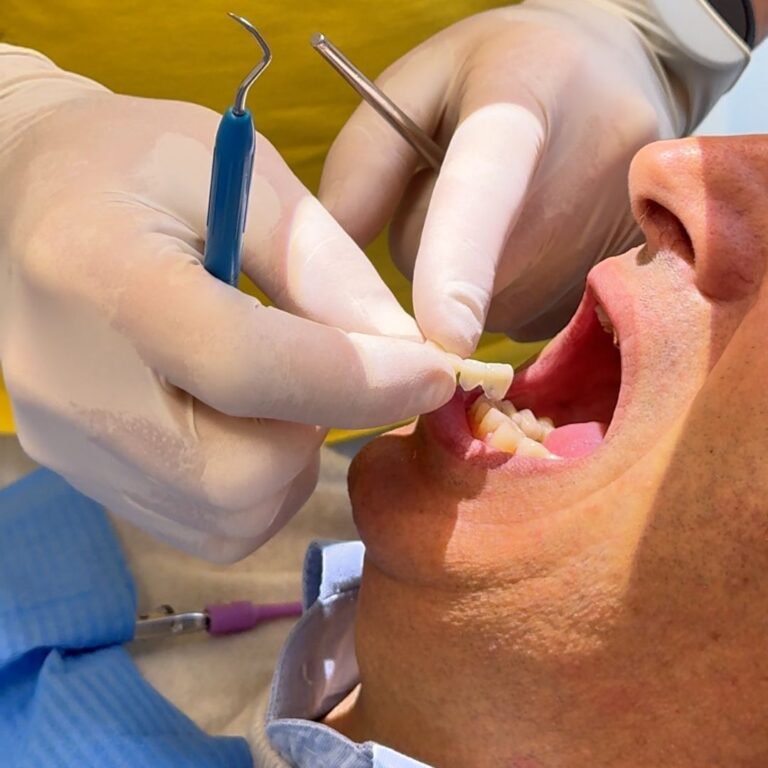 Come cambiano i denti con le faccette dentali, Faccette dentali e cambiamento estetico